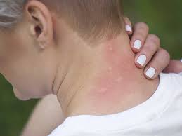 Bed bugs like to live close to where you spend a lot of your time, which is why bedrooms are often ground zero for bed bug infestations. Insect Sting Allergy Basics What Are Allergies