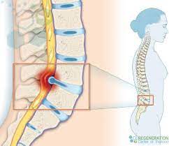 Can Stem Cells Help Reverse Degenerative Disc Disease