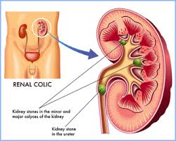 Pin By Nadia Jensen On Med School Kidney Stones Kidney Biopsy Kidney Stones Symptoms
