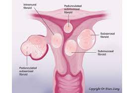 The most common symptoms of uterine fibroids include Can Uterine Fibroids Be Malignant Or Cancerous Sydney Fibroid Clinic