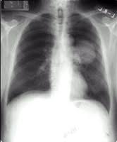 Signs and symptoms of lung cancer typically occur when the disease is advanced. Small Cell Lung Cancer Life Expectancy Symptoms Causes Stages