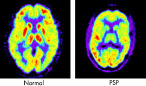 Progressive Supranuclear Palsy Causes Symptoms Stages Treatment