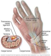 Carpal tunnel syndrome (cts) occurs when the median nerve, which runs from the forearm into the palm of the hand, becomes pressed or squeezed at contributing factors include trauma or injury to the wrist that cause swelling, such as sprain or fracture; Athens Ga Carpal Tunnel Syndrome Reddy Medical Group
