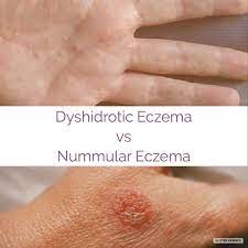 Dyshidrotic Eczema Small Itchy Blisters On Edges Of The Fingers Toes Palms Soles Of The Feet Skin Eczema Eczema Triggers Nummular Eczema