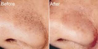 Aluminum oxide is known to be abrasive in texture. Mikrodermabrasion Vorher Nachher Micro Needling