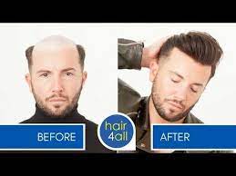 Before After Hair System Non Surgical Hair Replacement System For Men Women Youtube Hair Replacement Systems Hair System Hair Replacement