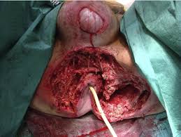 Die rechtzeitige diagnose mit sofortigem beginn einer antibiose, intensivtherapie der urosepsis und schneller . Figure 2 From Fournier S Gangrene Complicating Ulcerative Pancolitis Semantic Scholar