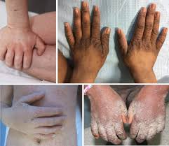 Image result for scabies human children
