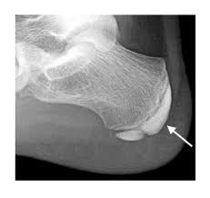 Image result for Calcaneal Apophysitis