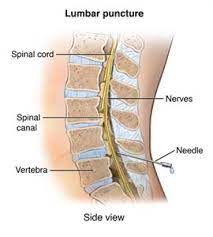 Transverse Myelitis Johns Hopkins Medicine