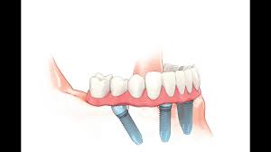 We specialize in lubbock emergency dentistry: All On 4 Implants Lubbock Tx Teeth In A Day