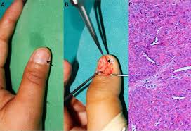 Image result for Glomus tumor