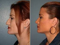 Best Plastic Surgeons For Nose Jobs Nose Job Nose Plastic Surgery Nose Reshaping