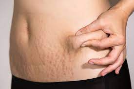 Setelah itu, oleskan ke bagian kulit yang. 5 Cara Alami Menghilangkan Stretch Mark Di Perut Womantalk