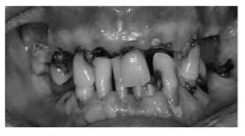 Questo anziano signore è un prodigio nel farsi volteggiare la dentiera in bocca a ritmo di musica !!! Le Malattie Del Cavo Orale Delle Persone Anziane Studio Dentistico Caneva