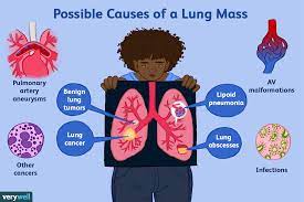 These changes are the result of the interaction between a person's genetic factors and three. Possible Causes Of A Lung Mass