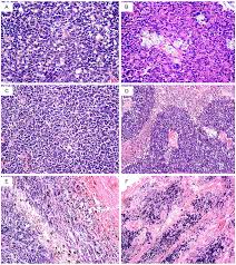 10 many retinoblastomas have underlying elements of retinoma. Retinoblastoma A Well Differentiated Tumour With Foci Of Download Scientific Diagram