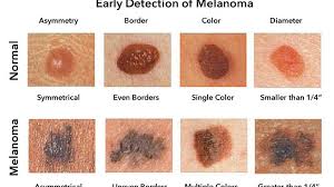 But hearing the words can still be scary. Melanoma Skin Cancer Treatment And Its Types Yashoda Hospital