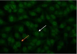 Image result for ANA Staining Pattern