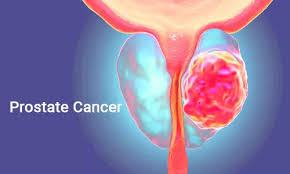 Your blood tests will also show a higher psa and alkaline phosphatase. Scooper Undefined News 7 Ways To Know If You Have Prostate Cancer