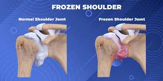 Image result for Frozen Shoulder