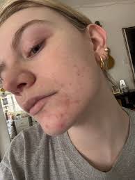 Has anyone used Zoryve cream