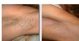 Safe, comfortable, permanent hair removal. Laser Hair Removal Before After Images Of Laser Hair Removal