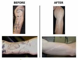 It uses some physical properties of thermolysis (photoselective) to remove the pigment of the tattoo. Pristine Laser Center The Pioneer In Laser Tattoo Removal Pristine Laser Center Orlando