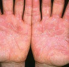 Health What Is Exfoliative Keratolysis Skin Peeling Treatment Essential Oil Skin Care Skin Disorders