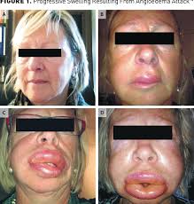 PDF] Severity of hereditary angioedema, prevalence, and diagnostic  considerations.