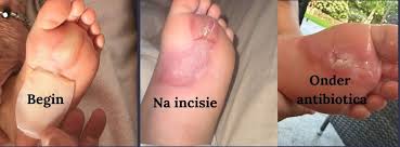 Image result for Impetigo