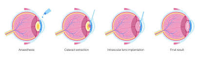 Image result for Cataract Extraction