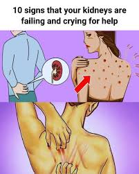 Als je nieren niet goed werken, geeft je lichaam deze 10 signalen 👇👇👇