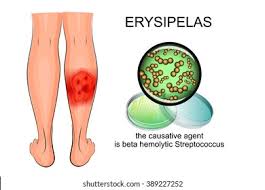 Image result for erysipel photos)