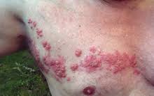 Herpes Zoster Wikipedia