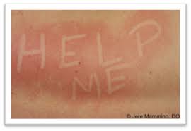 Image result for Dermatographism