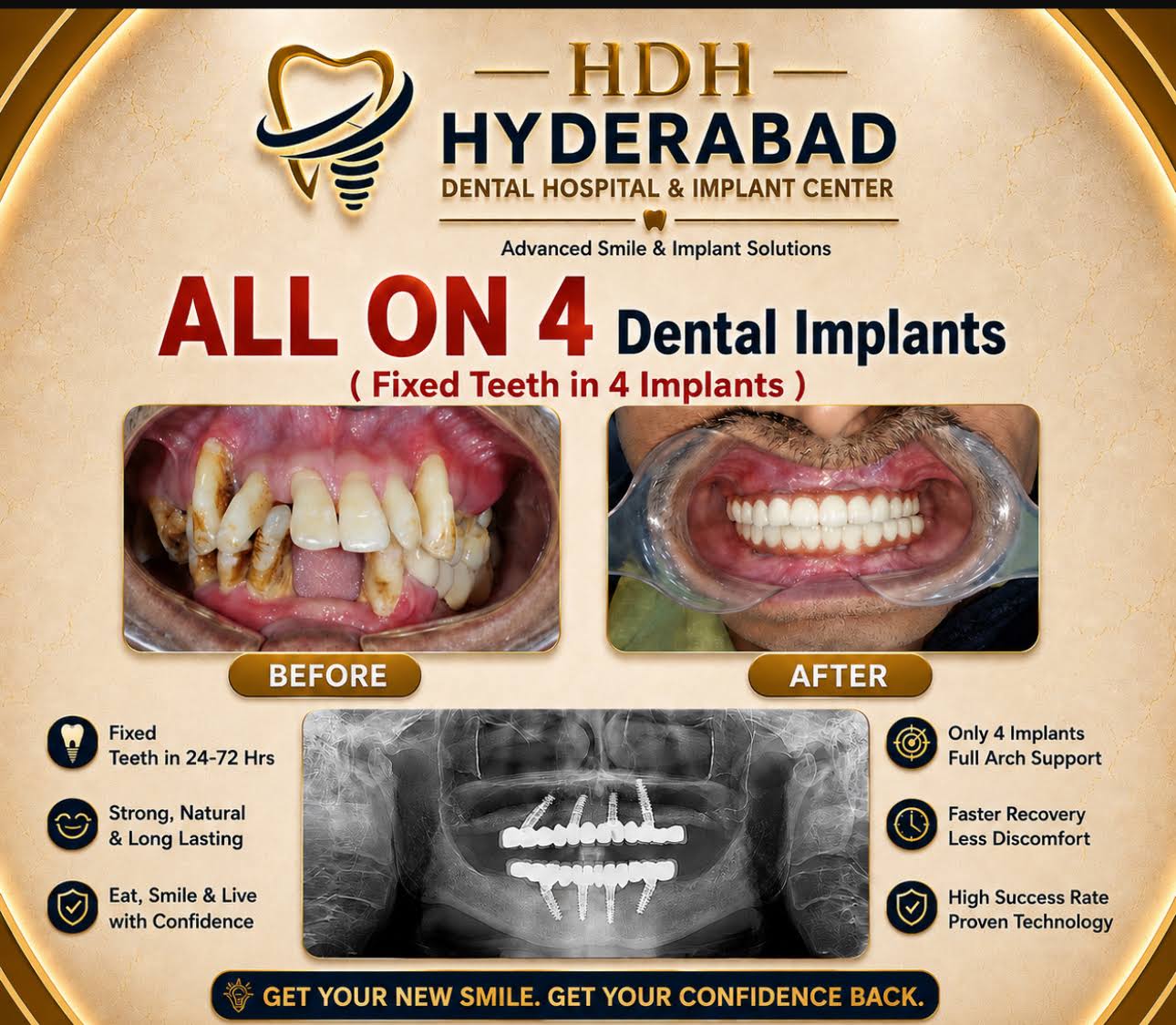 Immediate multiple teeth Replacement with Dental implants product image
