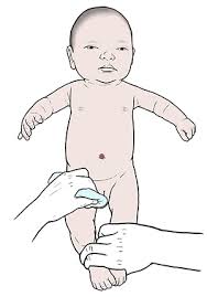The most common side effects are bleeding and infection. Care After Circumcision Spectrum Health Lakeland