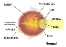 Image result for Refractive Error
