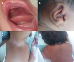 Image result for Webbed Neck