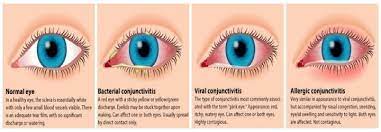 Pink Eye Conjunctivitis Causes Home Remedies Pink Eyes Treating Pink Eye Pinkeye Remedies