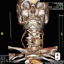 The truth is that blunt force head trauma can be caused by any blow to the head which does not penetrate the skull. 36 Year Old Male Imaged Following Blunt Force Trauma To Right Side Of Download Scientific Diagram
