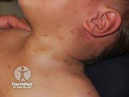 Image result for Urticaria pigmentosa children