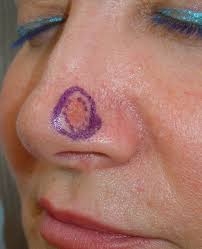 Check spelling or type a new query. Chirurgie 3d Micrographique Chirurgien Cancer Peau Paris Dr Tchakerian