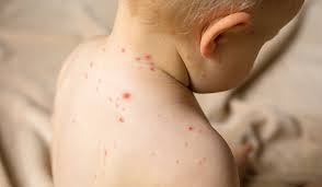 Image result for vyrážka u dětí
