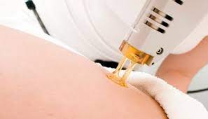 It's clear that more awareness is needed on what causes. Can Laser Hair Removal Cause Cancer