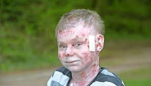 Unterstützung für Daniel Masutt mit Epidermolysis bullosa