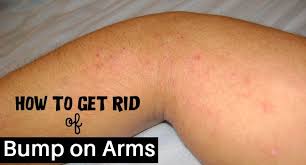 Have You Ever Waked Up With Bumps On Your Arms Or Legs You May Assume That They Are Tiny Pimples Or Hives It Makes Your Bumps On Arms Skin Bumps