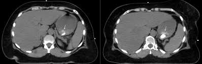 Long story short i have a ct scan with contrast on 1st june to look for cancer in the abdominal cavity. Ct Abnormality In Patient With Stage Ii Breast Cancer History