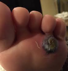 Scholl's clear away plantar wart remover uses salicylic acid to help you remove warts at home. 1201 Best R Warts Images On Pholder Some Days After The Salicylic Acid I Removed Some Dead Skin And Put Some More Acid Again I Think It Might Fall Soon The Fker